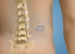 neurostimulation medullaire