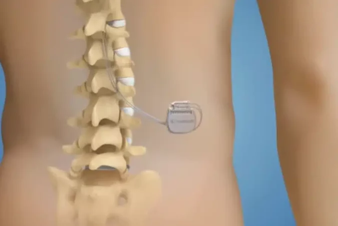neurostimulation medullaire