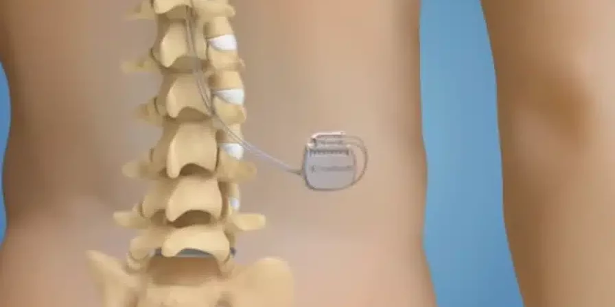 neurostimulation medullaire